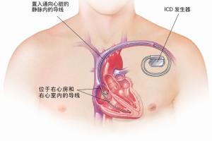 击败死神！埃里克森植入的ICD揭秘：能否进行高强度运动？